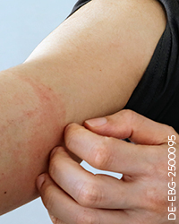 EBGLYSS_Advertorial_ET20250606_biermann_200x250_20250515