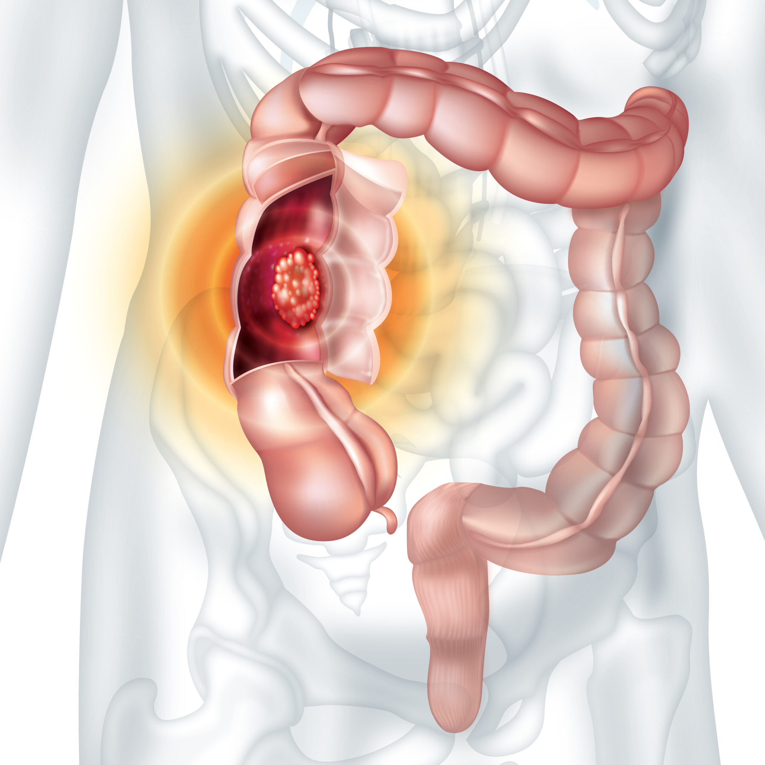 Colon Cancer