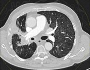 Lungenkrebs: Höhere Strahlendosis ist sicher und vielversprechend