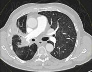 Lungenkrebs: Höhere Strahlendosis ist sicher und vielversprechend