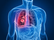 ASCO 2025: 14-Gen-Test verrät, bei welchem frühen NSCLC eine Chemotherapie angezeigt ist