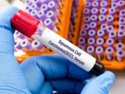 Kutanes Plattenepithelkarzinom: Neuer Biomarker C5aR1 entdeckt