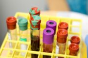 Stammzellähnliche Zellen sind bei Kindern mit Blutkrebs der Grund für Rückfälle