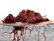 Behandlung fortgeschrittener Melanome mit onkolytischem Herpesvirus