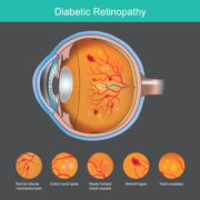 Diabetische Retinopathie: Neuartiger KI-gestützter mobiler Retina-Tracker entwickelt