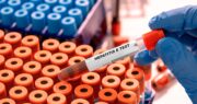 ALM: „Labordiagnostik als Schlüssel zur frühzeitigen Hepatitis-Erkennung bewahren“
