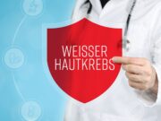 Antivirale Therapiemöglichkeit gegen kutane humane Papillomviren entdeckt