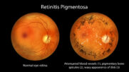 Retinitis pigmentosa: Stäbchenzellen verdrahten sich neu, wenn die Sehkraft schwindet