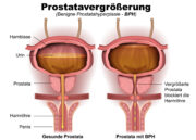 Retraktion der Prostata bei BPH: G-BA fordert Medizinprodukthersteller zur Meldung auf