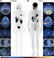 Nasopharynxkarzinom: Neuer PET-Bildgebungsansatz ermöglicht präzise Biomarker-Kartierung
