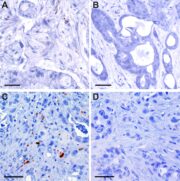 Bauchspeicheldrüsenkrebs: Antibiotika können das Leben von Patienten verlängern