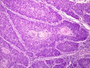 Beta-HPV kann bei immungeschwächten Personen direkt Hautkrebs verursachen