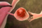 Immunlandschaften von Eierstocktumoren liefern Hinweise auf bessere Therapie