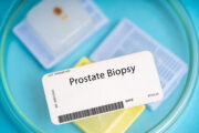 Prostatakrebs: Biopsie-Ergebnisse können das Risiko unterschätzen