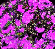 Immunzellen der Tumorumgebung entscheiden über Therapieerfolg bei kindlichen Hirntumoren