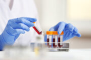 Wie zuverlässig ist Neurofilament Light Chain als Biomarker?