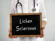 Neue Leitlinie zu Lichen sclerosus empfiehlt Corticoidtherapie