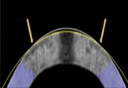 Hornhautkorrektur: EMR als Alternative zur LASIK – ohne Laser