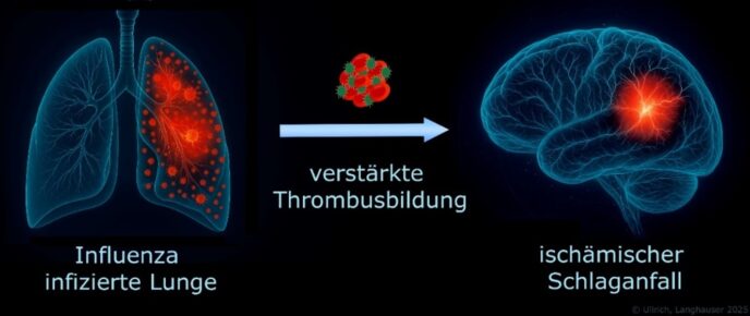 Blutgerinnselbildung bei viralen Infekten erhöht Schlaganfallrisiko.