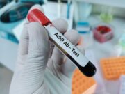 Diagnose der Myasthenia gravis: Vorsicht bei niedrigen Antikörper-Titern