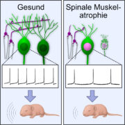 Auch das Kleinhirn spielt bei Spinaler Muskelatrophie eine Rolle