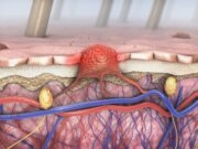 Erste Evidenz für eine zielgerichtete Therapie bei NRAS-mutiertem Melanom