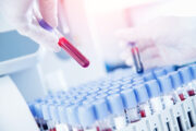 Frühzeitige Krebsdiagnose dank Flüssigbiopsie?