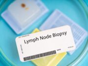 Melanom: Neuer Test als mögliche Alternative zur Lymphknotenbiopsie