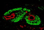 Bauchspeicheldrüsenkrebs bildet eigene „Synapsen“