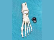 Komplettes Sprungbein erstmals per 3D-Druck ersetzt