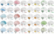 „Methylation Classifier“: KI-gestützte molekulare Krebsdiagnose bei Hirntumoren