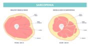 Studie zeigt: Jeder vierte Typ-2-Diabetiker leidet an „sarkopenischem Diabetes“