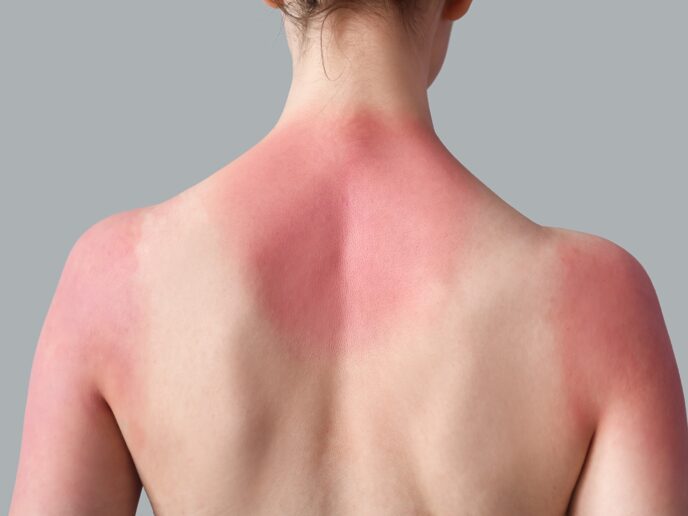 Frau mit Sonnenbrand