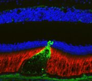 AMD: Neues genetisches Risiko für schwere Verlaufsformen identifiziert