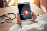 Fortgeschrittener Brustkrebs: Gen Rb1 könnte als prädiktiver Biomarker für neue Therapiestrategie dienen