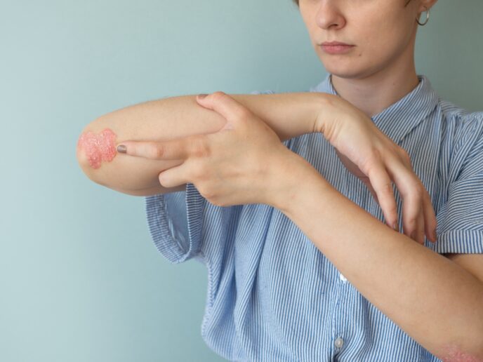 Frau zeigt ihren Ellenbogen mit Psoriasis-Läsion