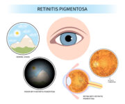 Retinitis pigmentosa: Die blinde Stelle des Genoms finden