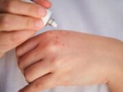 Mehr Aufklärung bei topischen Corticosteroiden erforderlich
