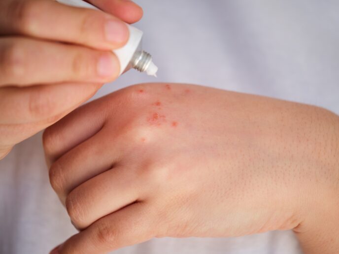 Frau cremt einen Ausschlag auf ihrer Hand ein