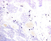 Mastzellen bei Interstitieller Zystitis/Blasenschmerzsyndrom: Hohe Inkonsistenz bei pathologischen Berichten