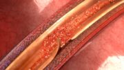 Registerergebnisse zur spontanen Koronararteriendissektion: Stentimplantation vermutlich nicht von Vorteil