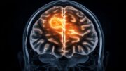 3D-Modell eröffnet neue Ansatzpunkte für Therapien von Hirnmetastasen nach Brustkrebs