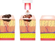 Melanom: Behandlung mit niederenergetischem Laserlicht und Nanopartikeln