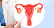 Risikofaktoren für Malignität bei Endometriumpolypen