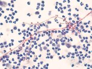 Melanom: Candida albicans unterstützt maligne Zellen