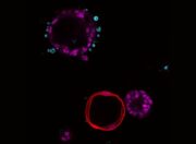 Vorbereitung der Tumorumgebung: Möglicher Biomarker für früheste Entstehungsphase des Pankreaskarzinoms gefunden