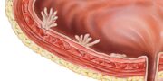 Nicht muskelinvasiver Hochrisiko-Blasenkrebs birgt auch 25 Jahre nach Diagnose noch Gefahr