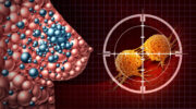 TNBC: Zielgerichtete Therapie plus CAR-T-Zellen als neuer Ansatz