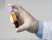 Chronische Hepatitis B: Biomarker für Vorhersage eines erhöhten Leberkrebsrisikos identifiziert