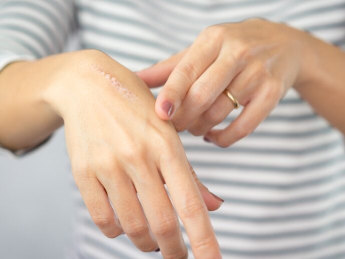 Narbe auf Handrücken